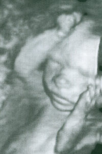 Contributed Baby boy Steele is about 20 weeks gestation in this ultrasound image. 