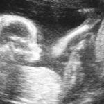 Oral arguments heard in fetal heartbeat lawsuit in Iowa